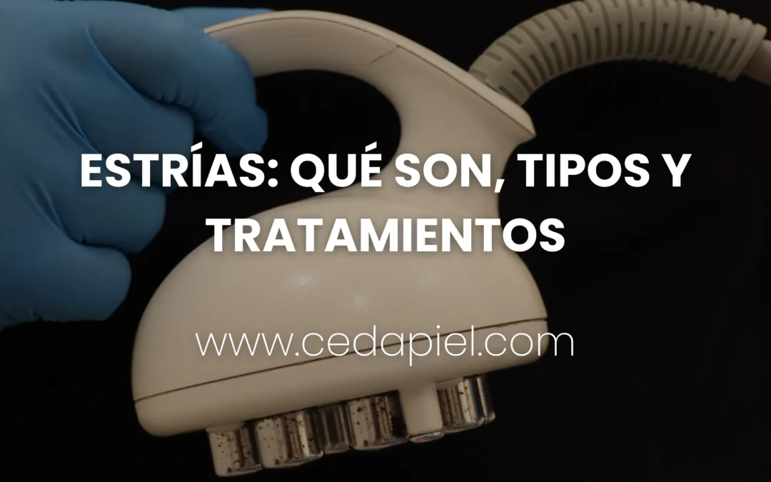 Estrías: Qué son, tipos y tratamientos efectivos