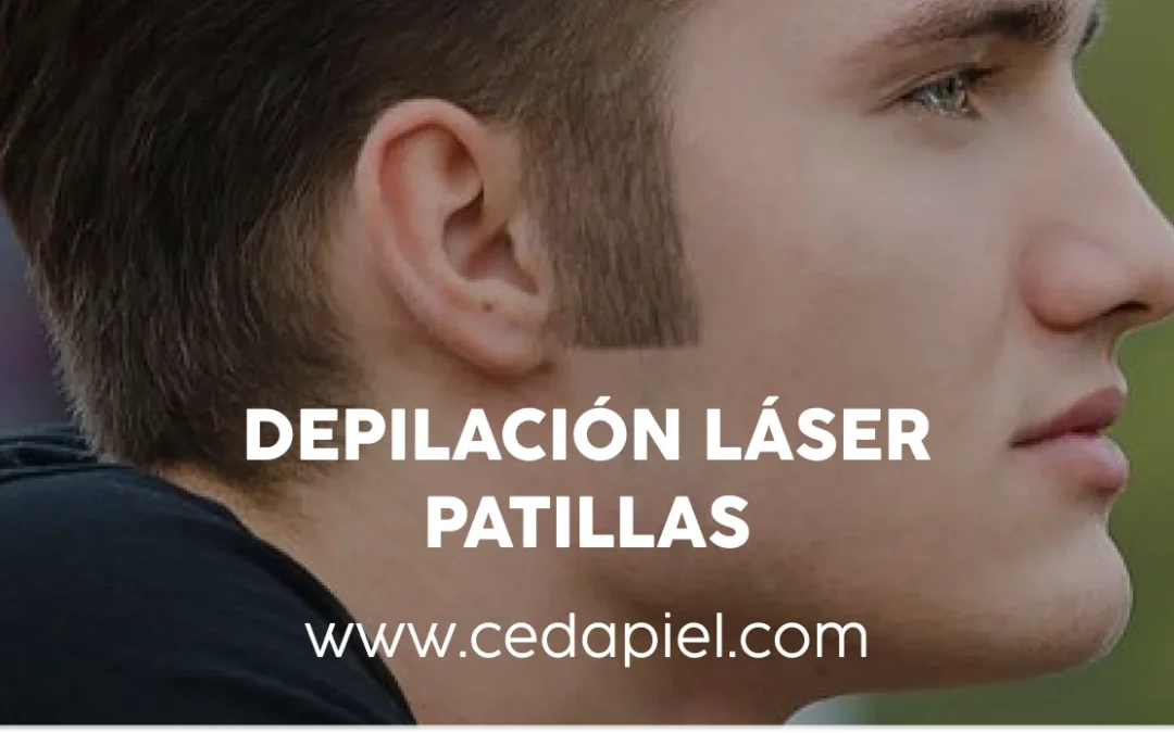 Depilación láser de patillas