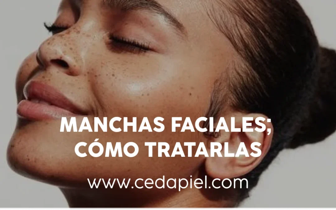 Manchas faciales | Tipos y tratamientos efectivos | Cedapiel