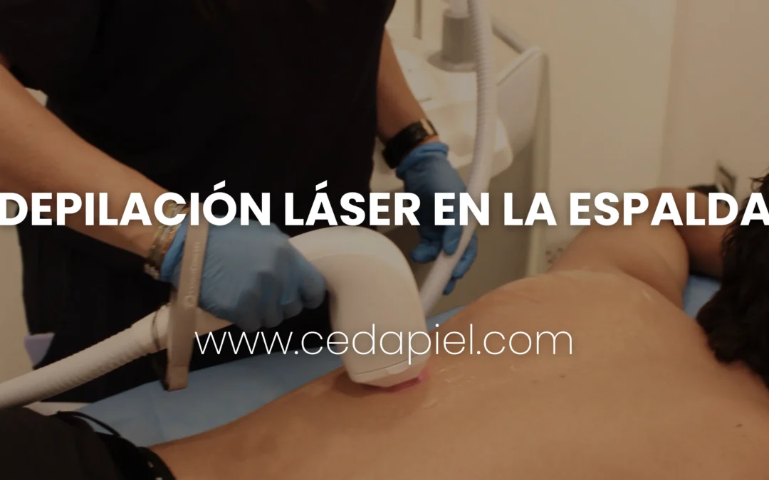 Depilación láser en la espalda