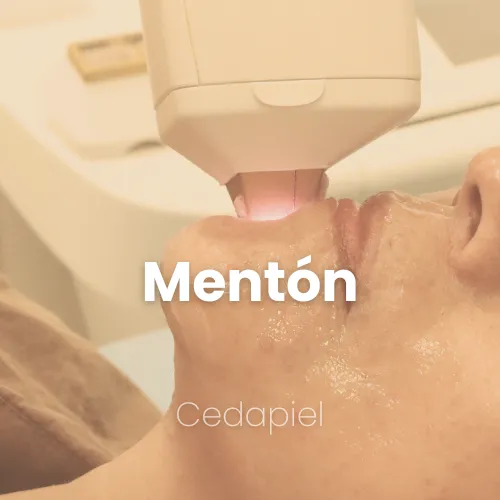 depilación laser de mentón cedapiel