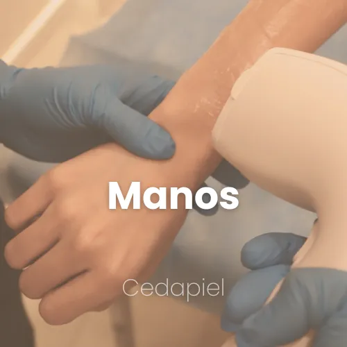 Depilación láser de manos cedapiel