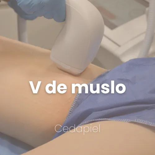 Depilación laser v de muslo cedapiel