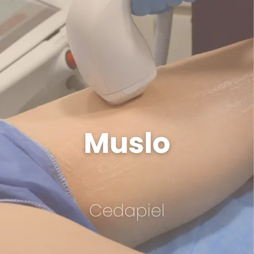 depilacion laser de muslo cedapiel