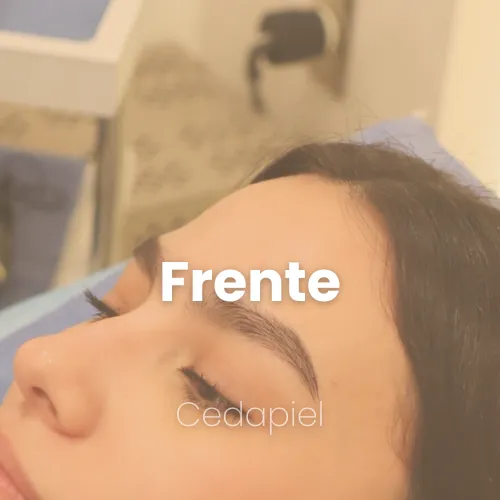 depilación láser de frente cedapiel