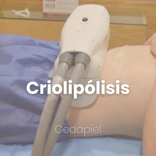 Criolipolisis cedapiel